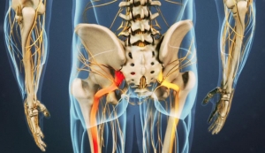 sciatica